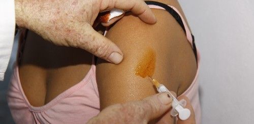 Lanzarote registra 600 casos semanales de gripe A