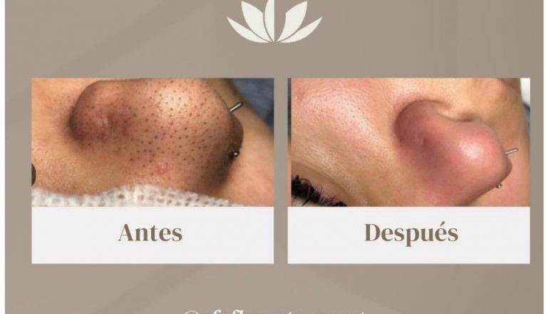 Efectos de Hydrofacial